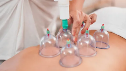 Foto demonstrativa de Ventosaterapia: o que é e para que serve esse tratamento?