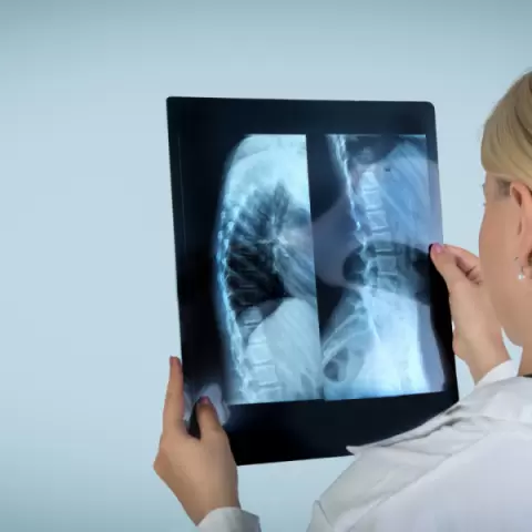 Foto demonstrativa de Escoliose O Impacto na Postura e a Importância do Tratamento Fis